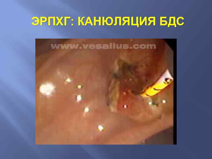 ЭРПХГ: КАНЮЛЯЦИЯ БДС 