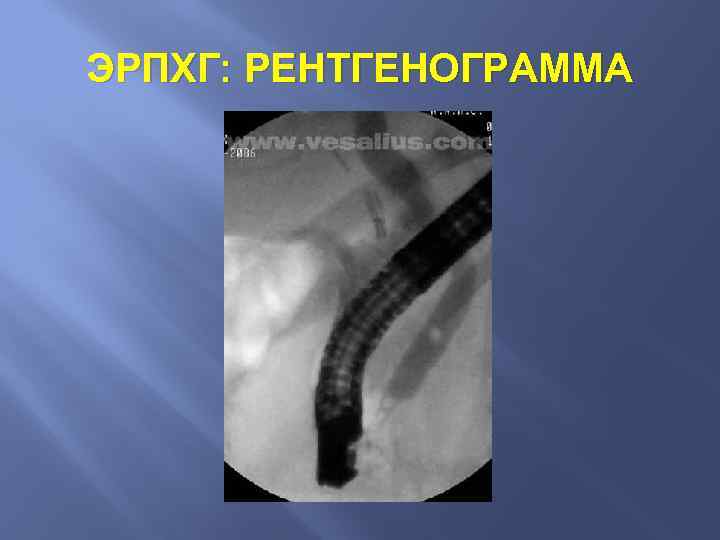 ЭРПХГ: РЕНТГЕНОГРАММА 