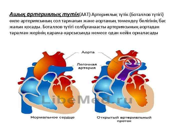 Ашық артериялық түтік(ААТ) Артериялық түтік (Боталлов түтігі) өкпе артериясының сол тармағын және аортаның төмендеу
