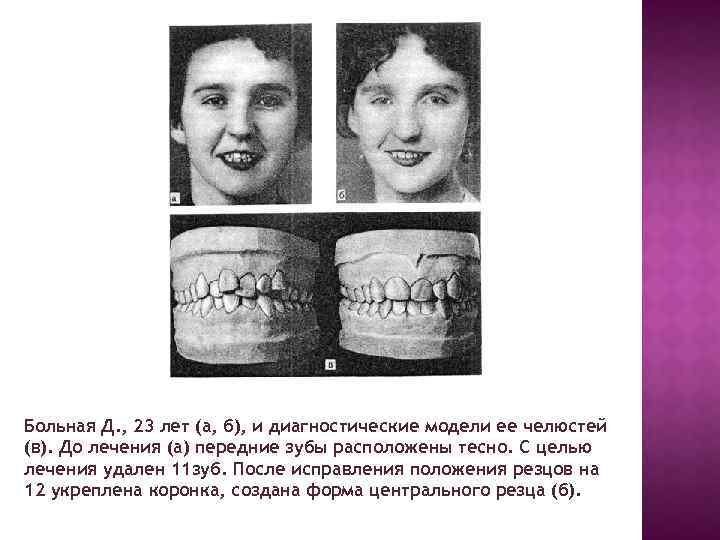 Больная Д. , 23 лет (а, б), и диагностические модели ее челюстей (в). До