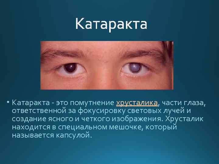  • Катаракта - это помутнение хрусталика, части глаза, ответственной за фокусировку световых лучей