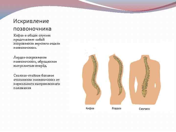 Какие бывают искривления