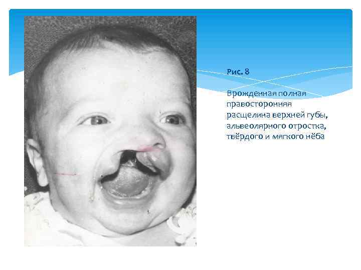 Рис. 8 Врожденная полная правосторонняя расщелина верхней губы, альвеолярного отростка, твёрдого и мягкого нёба