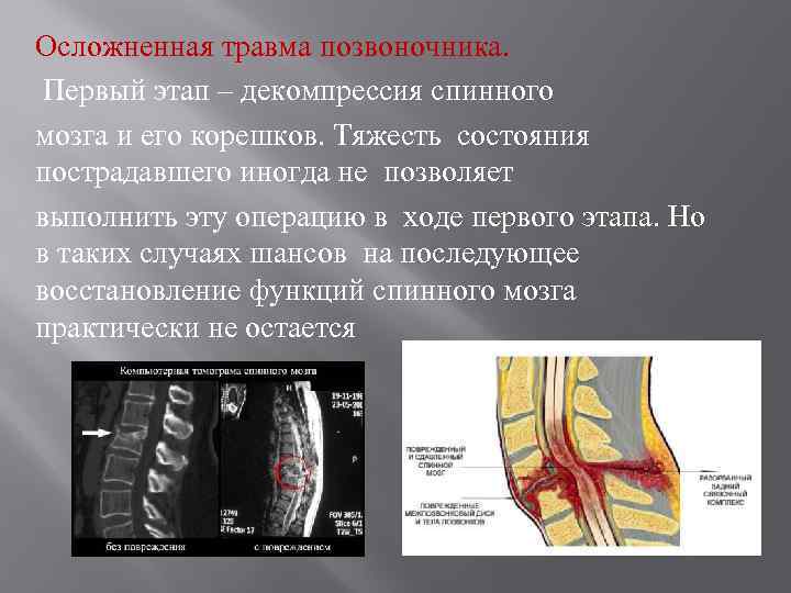 Осложненная травма позвоночника. Первый этап – декомпрессия спинного мозга и его корешков. Тяжесть состояния