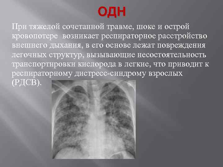 ОДН При тяжелой сочетанной травме, шоке и острой кровопотере возникает респираторное расстройство внешнего дыхания,