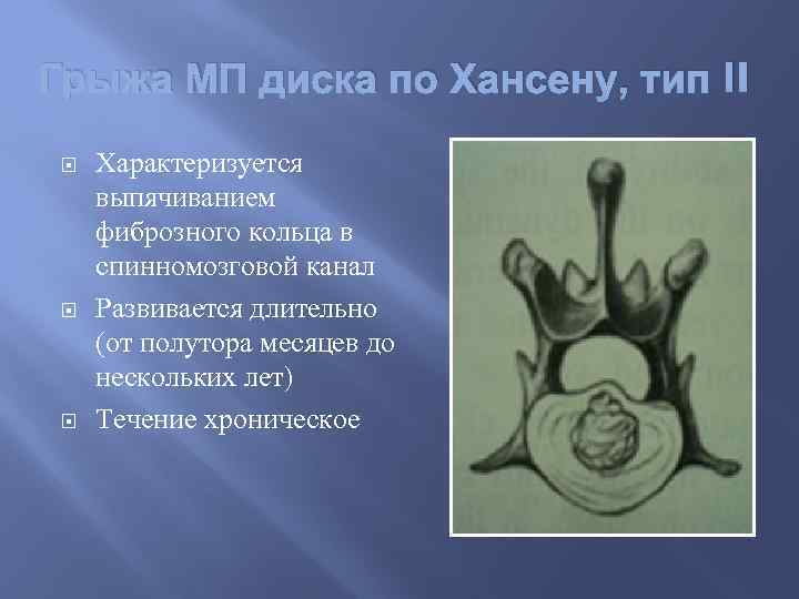 Грыжа МП диска по Хансену, тип II Характеризуется выпячиванием фиброзного кольца в спинномозговой канал