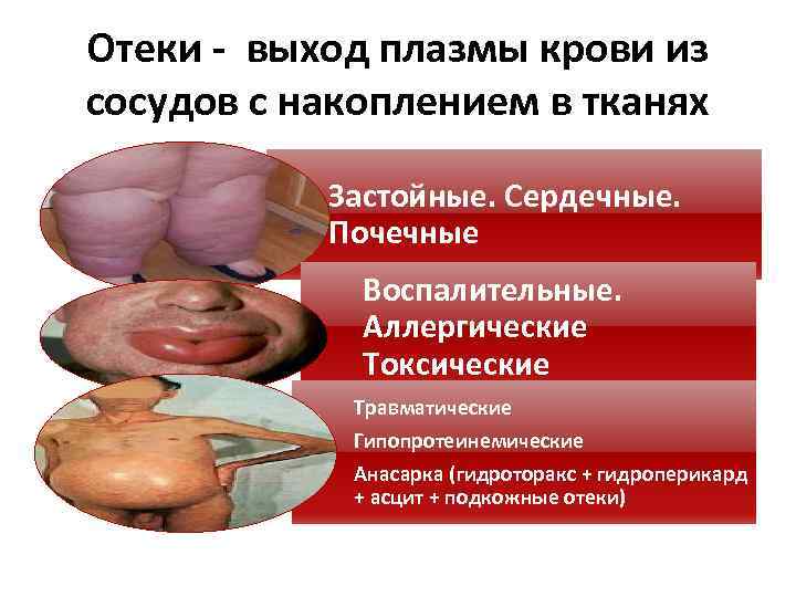 Отеки - выход плазмы крови из сосудов с накоплением в тканях Застойные. Сердечные. Почечные