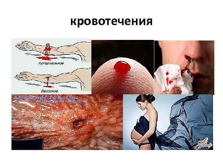 кровотечения 