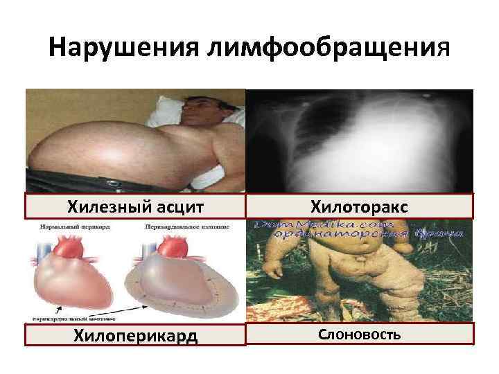 Нарушения лимфообращения Хилезный асцит Хилоторакс Хилоперикард Слоновость 