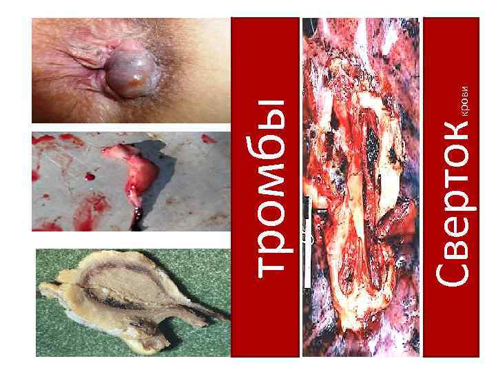 Сверток крови тромбы 