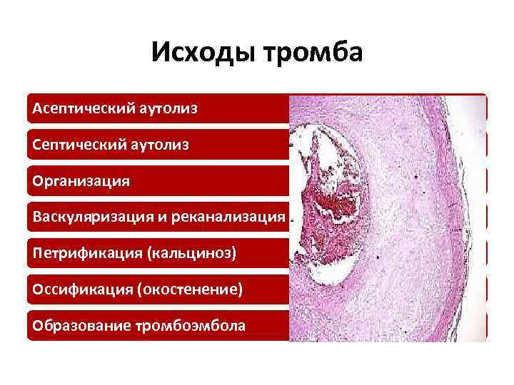 Исходы тромба Асептический аутолиз Септический аутолиз Организация Васкуляризация и реканализация Петрификация (кальциноз) Оссификация (окостенение)