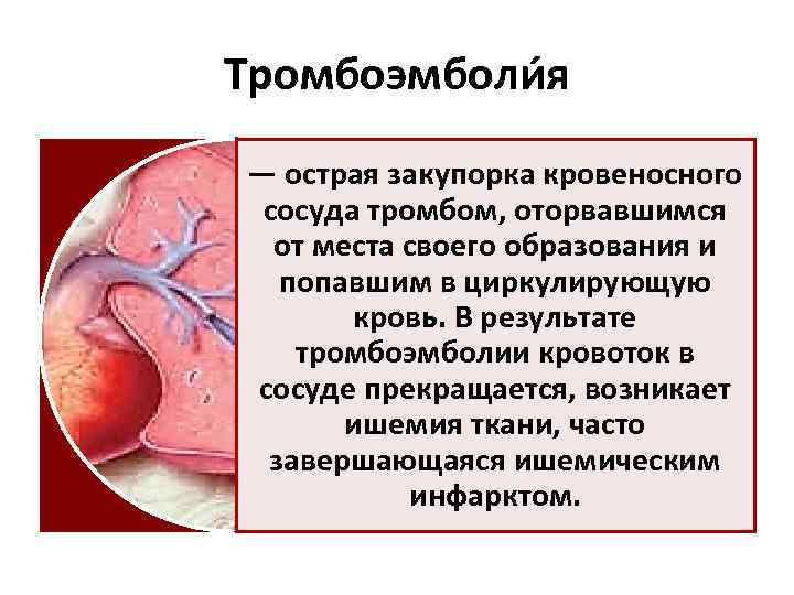 Тромбоэмболи я — острая закупорка кровеносного сосуда тромбом, оторвавшимся от места своего образования и