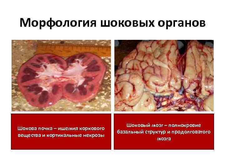 Морфология шоковых органов Шокова почка – ишемия коркового вещества и кортикальные некрозы Шоковый мозг