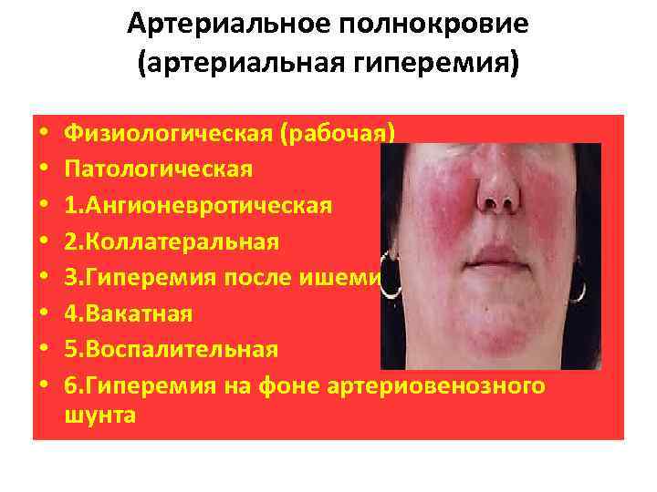 Артериальное полнокровие (артериальная гиперемия) • • Физиологическая (рабочая) Патологическая 1. Ангионевротическая 2. Коллатеральная 3.