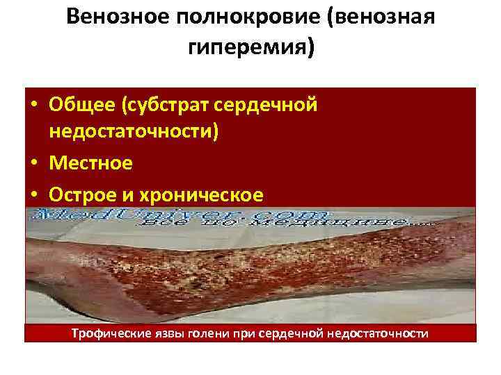 Венозное полнокровие (венозная гиперемия) • Общее (субстрат сердечной недостаточности) • Местное • Острое и