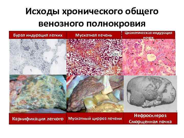 Исходы хронического общего венозного полнокровия Бурая индурация легких Мускатная печень Карнификация легкого Мускатный цирроз