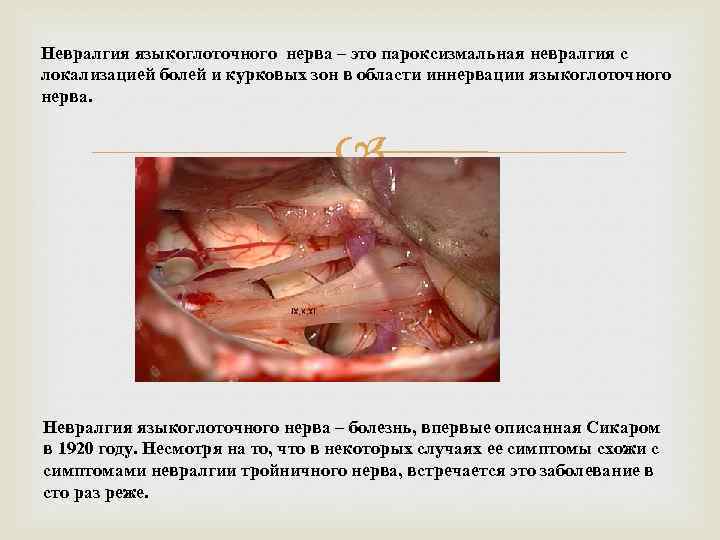 Невралгия языкоглоточного нерва – это пароксизмальная невралгия с локализацией болей и курковых зон в