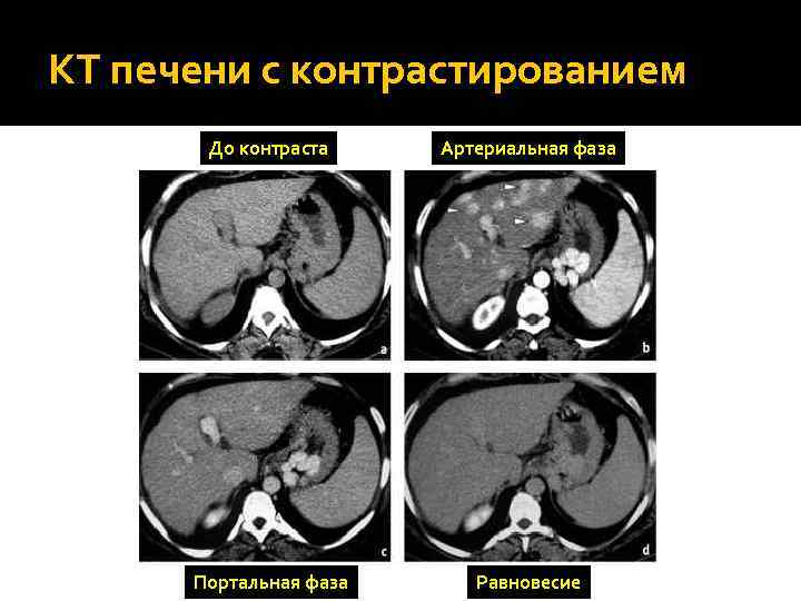 КТ печени с контрастированием До контраста Артериальная фаза Портальная фаза Равновесие 