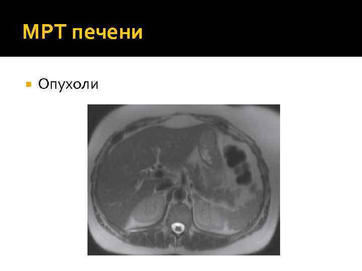 МРТ печени Опухоли 