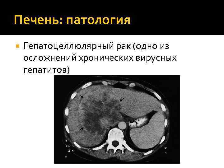 Печень: патология Гепатоцеллюлярный рак (одно из осложнений хронических вирусных гепатитов) 