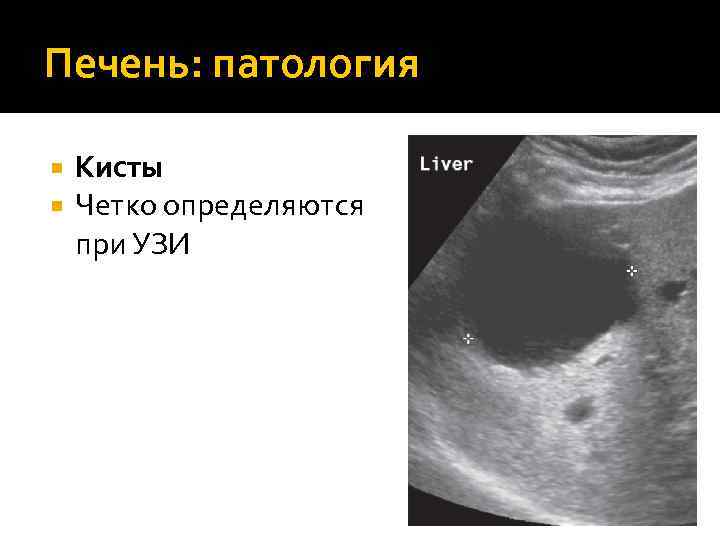 Печень: патология Кисты Четко определяются при УЗИ 