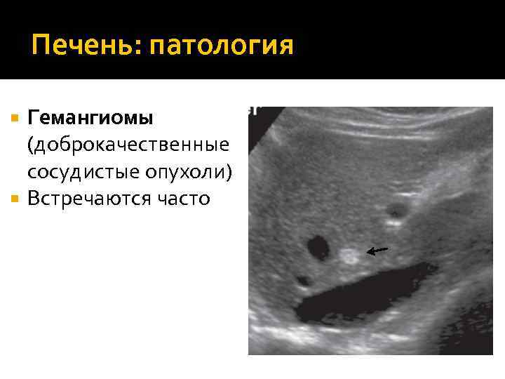 Гемангиома печени форум. УЗИ картина кавернозной гемангиомы печени. Доброкачественная опухоль гемангиома. Гемангиома печени на УЗИ описание.