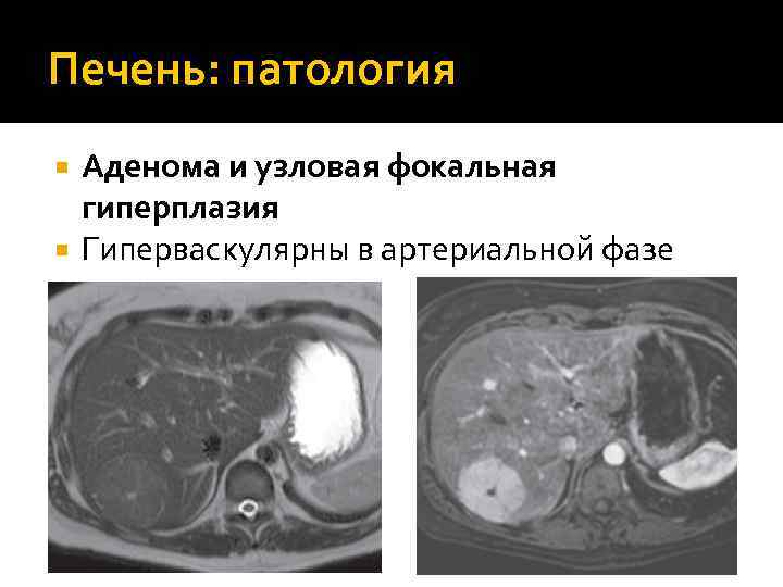 Печень: патология Аденома и узловая фокальная гиперплазия Гиперваскулярны в артериальной фазе 