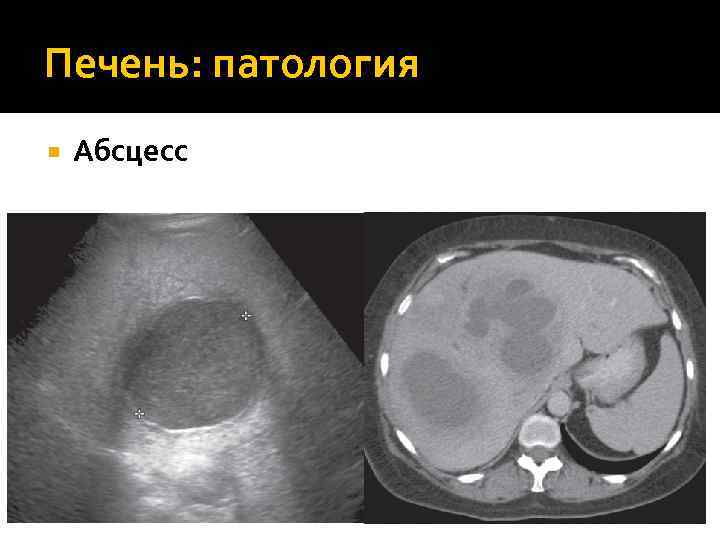 Печень: патология Абсцесс 