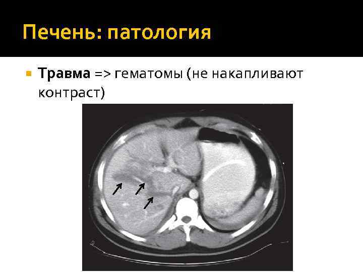 Печень: патология Травма => гематомы (не накапливают контраст) 