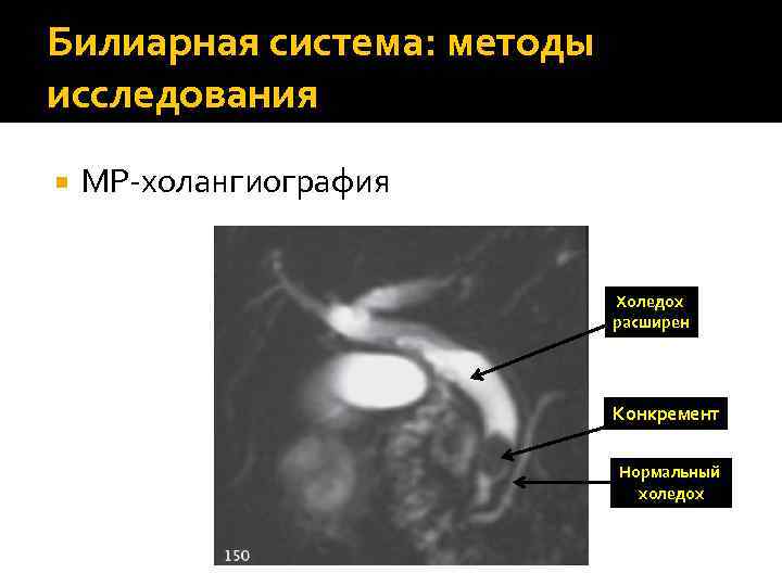 Билиарная система: методы исследования МР-холангиография Холедох расширен Конкремент Нормальный холедох 