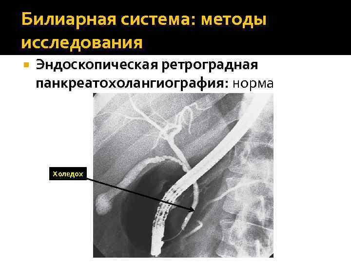 4 радиален. Холедох 11 мм что это такое. Холедох 8 мм. Холедох 13-14 мм. Извитой холедох.