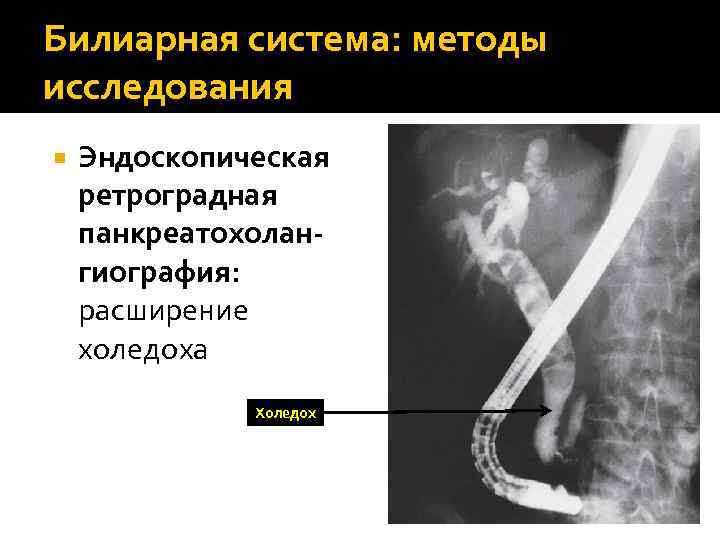 Билиарная система: методы исследования Эндоскопическая ретроградная панкреатохолангиография: расширение холедоха Холедох 