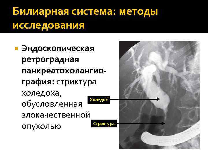 Билиарная система: методы исследования Эндоскопическая ретроградная панкреатохолангиография: стриктура холедоха, Холедох обусловленная злокачественной Стриктура опухолью