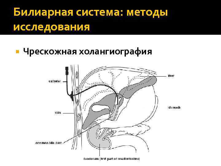 Билиарная система: методы исследования Чрескожная холангиография 