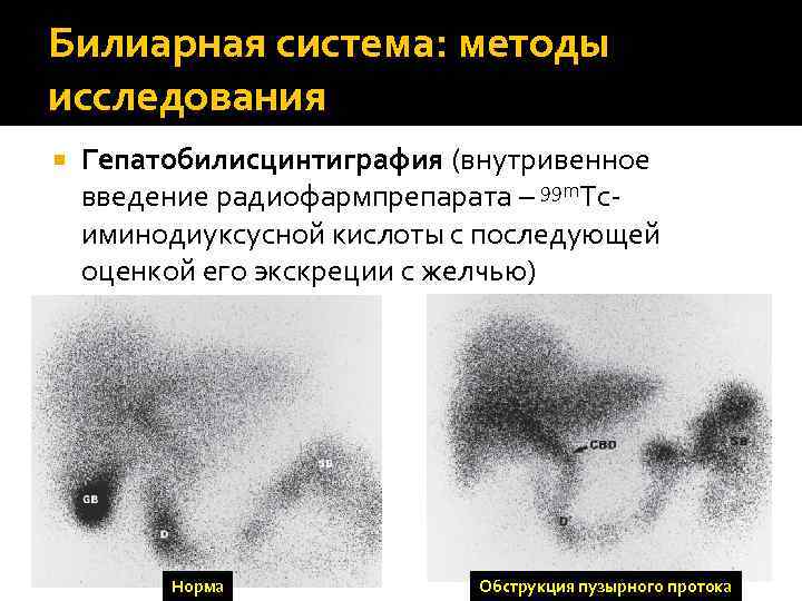 Билиарная система: методы исследования Гепатобилисцинтиграфия (внутривенное введение радиофармпрепарата – 99 m. Tcиминодиуксусной кислоты с