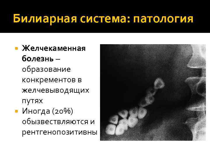 Билиарная система: патология Желчекаменная болезнь – образование конкрементов в желчевыводящих путях Иногда (20%) обызвествляются