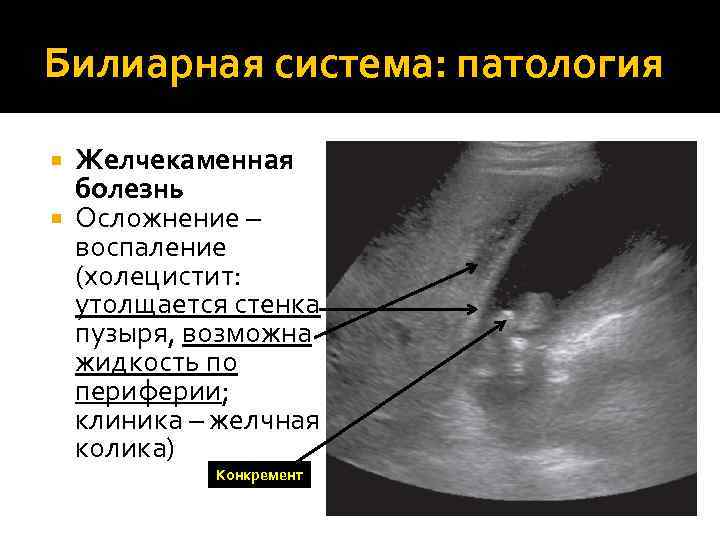 Билиарная система: патология Желчекаменная болезнь Осложнение – воспаление (холецистит: утолщается стенка пузыря, возможна жидкость