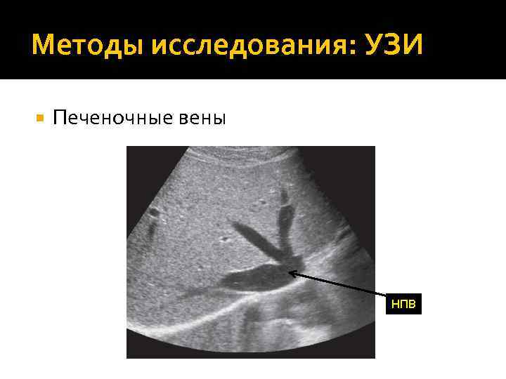 Методы исследования: УЗИ Печеночные вены НПВ 