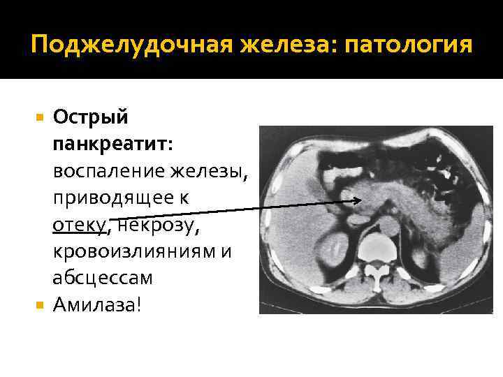 Поджелудочная железа: патология Острый панкреатит: воспаление железы, приводящее к отеку, некрозу, кровоизлияниям и абсцессам