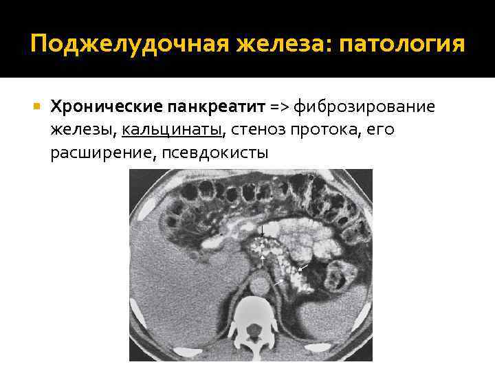 Поджелудочная железа: патология Хронические панкреатит => фиброзирование железы, кальцинаты, стеноз протока, его расширение, псевдокисты