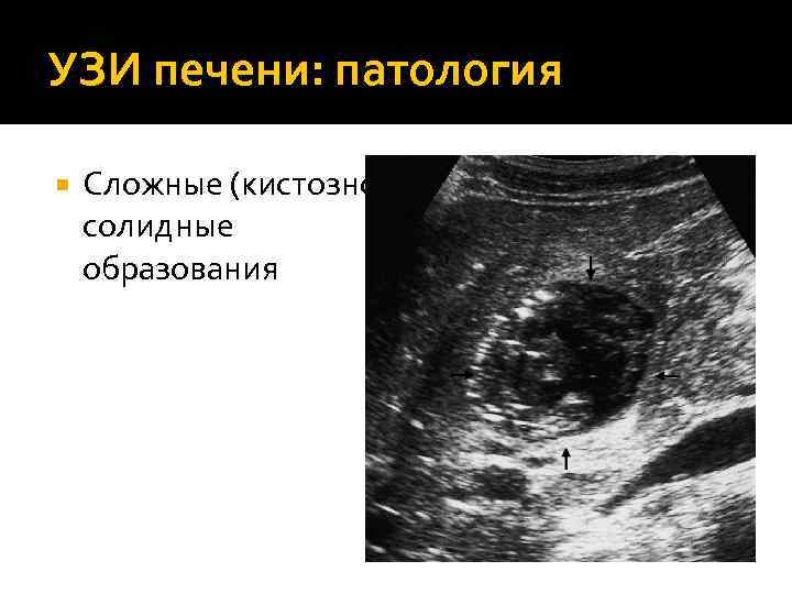 УЗИ печени: патология Сложные (кистозносолидные образования 