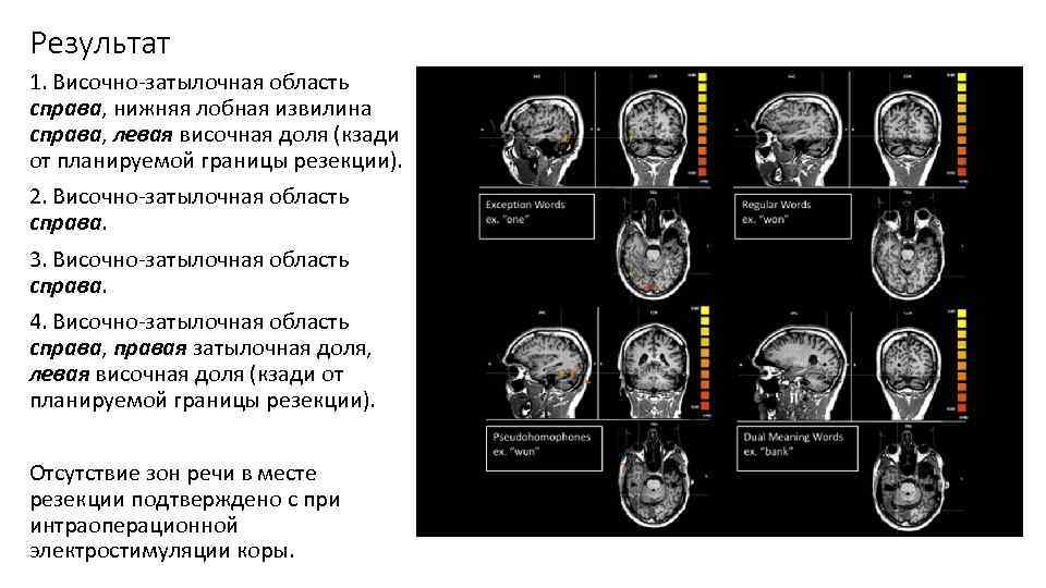 Результат 1. Височно-затылочная область справа, нижняя лобная извилина справа, левая височная доля (кзади от