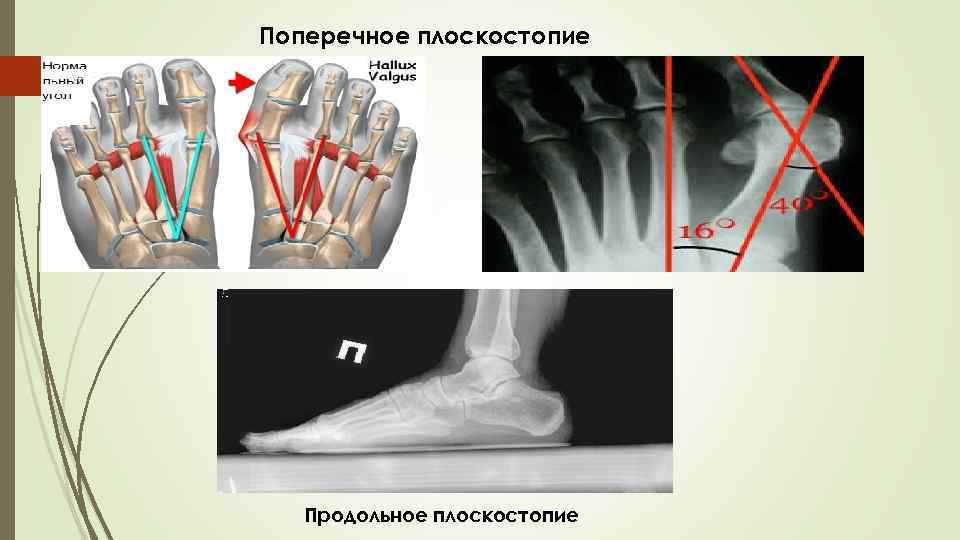 Продольное плоскостопие презентация