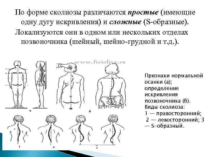 Миостимуляция при сколиозе схема