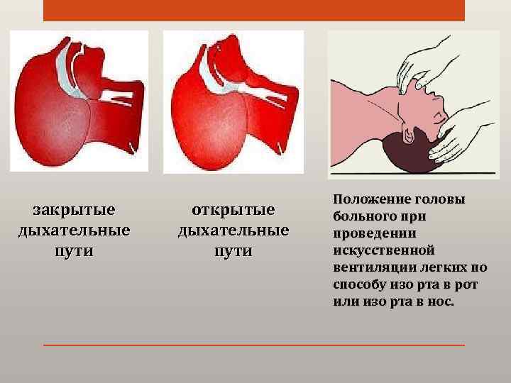 закрытые дыхательные пути открытые дыхательные пути Положение головы больного при проведении искусственной вентиляции легких