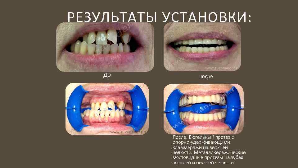 Замена матрицы в бюгельном протезе