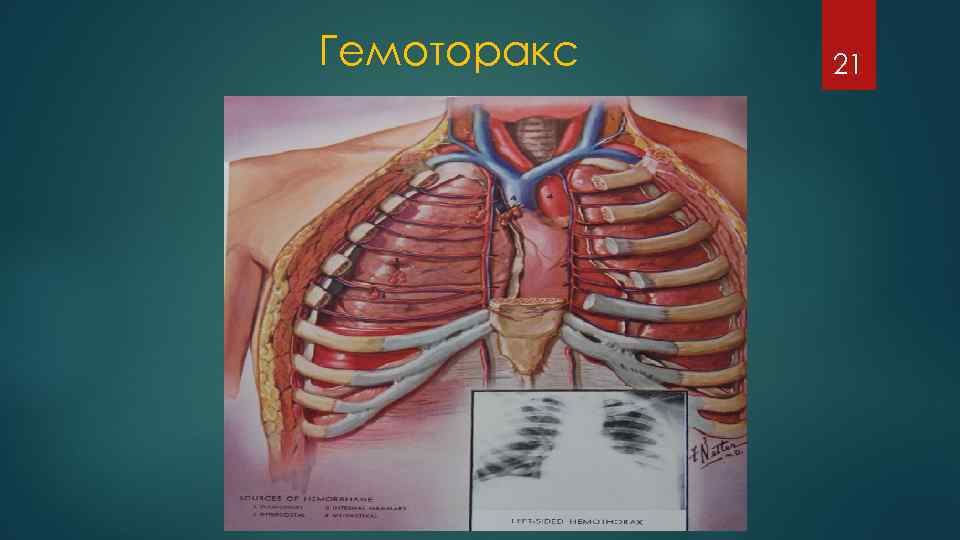 Гемоторакc 21 