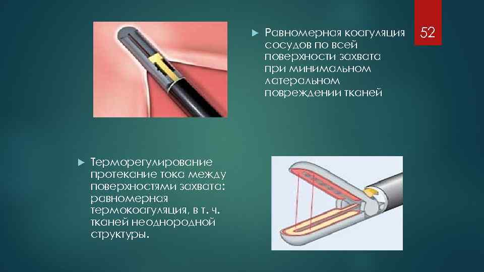  Терморегулирование протекание тока между поверхностями захвата: равномерная термокоагуляция, в т. ч. тканей неоднородной