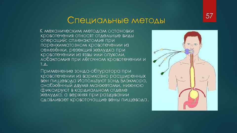 Специальные методы К механическим методам остановки кровотечения относят отдельные виды операций: спленэктомия при паренхиматозном