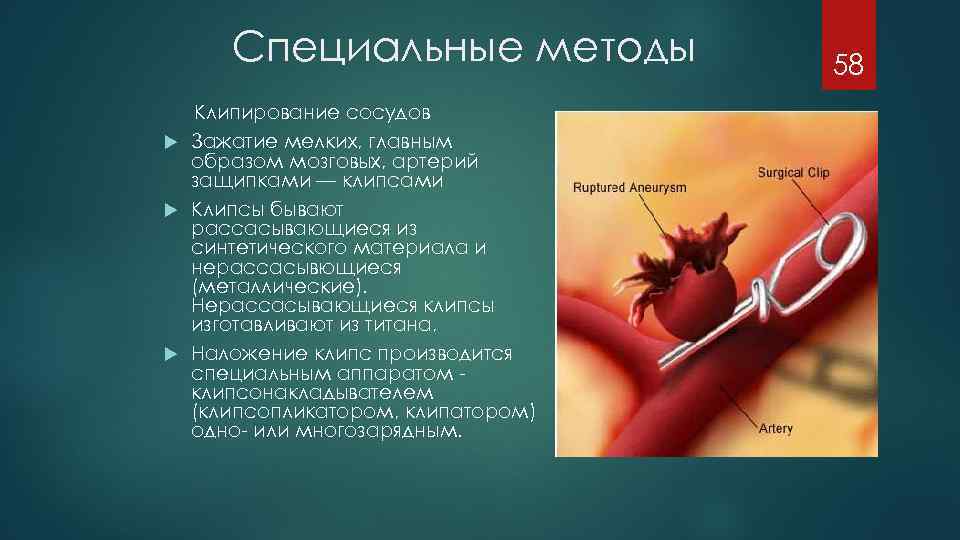 Специальные методы Клипирование сосудов Зажатие мелких, главным образом мозговых, артерий защипками — клипсами Клипсы